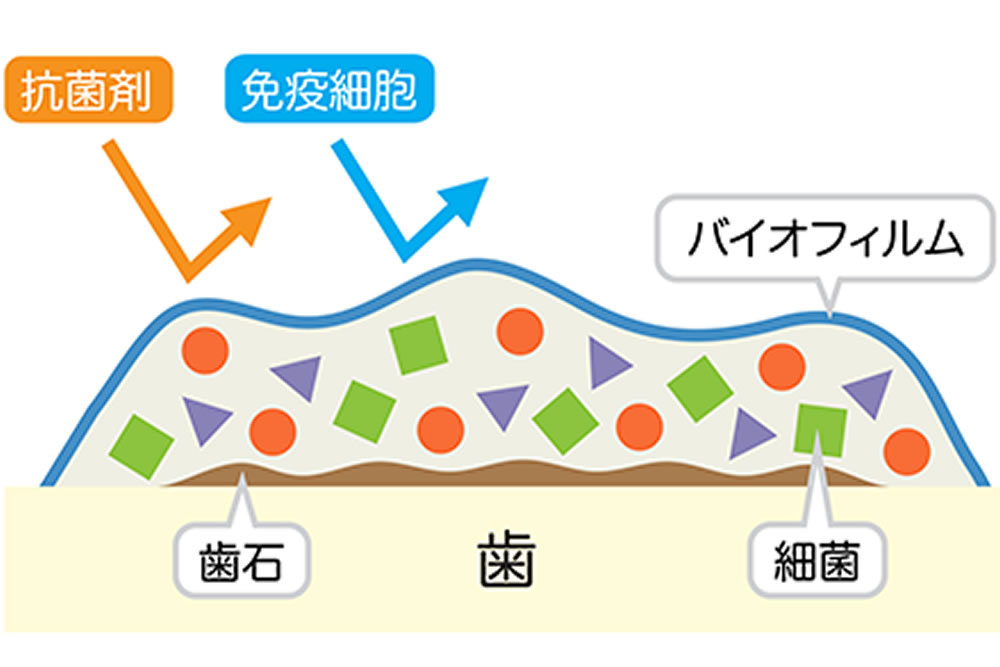 成田（千葉県成田市）の歯医者、メイプル歯科はなのき台クリニックの予防歯科