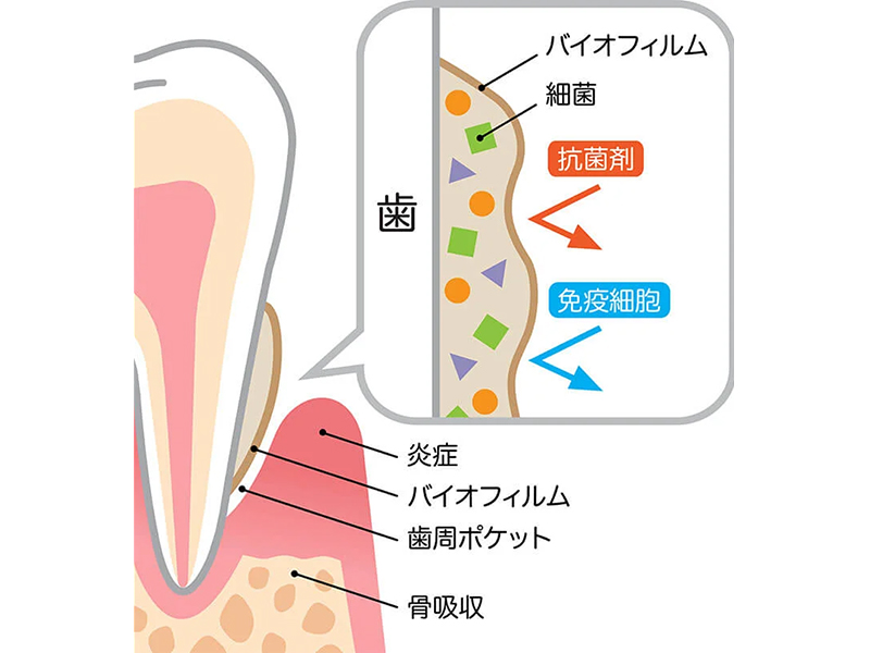 成田（千葉県成田市）の歯医者、メイプル歯科はなのき台クリニックの予防歯科