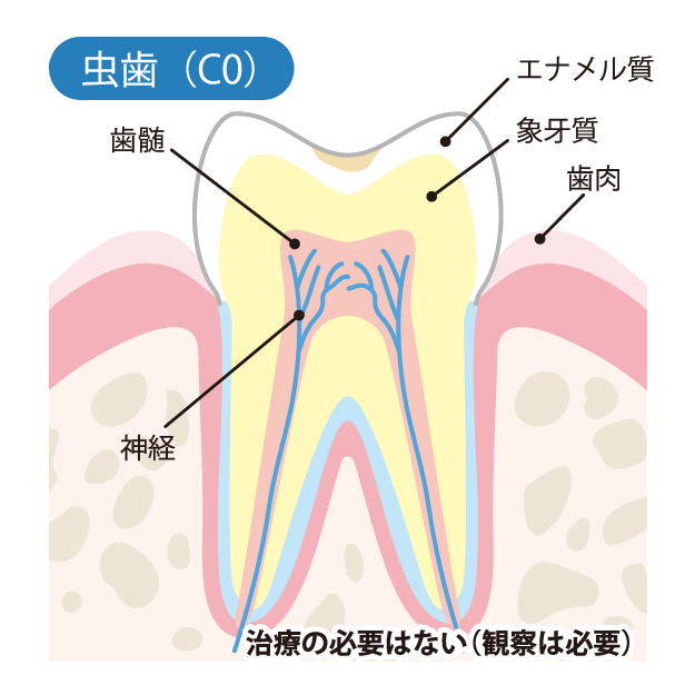 成田（千葉県成田市）の歯医者、メイプル歯科はなのき台クリニックの虫歯治療