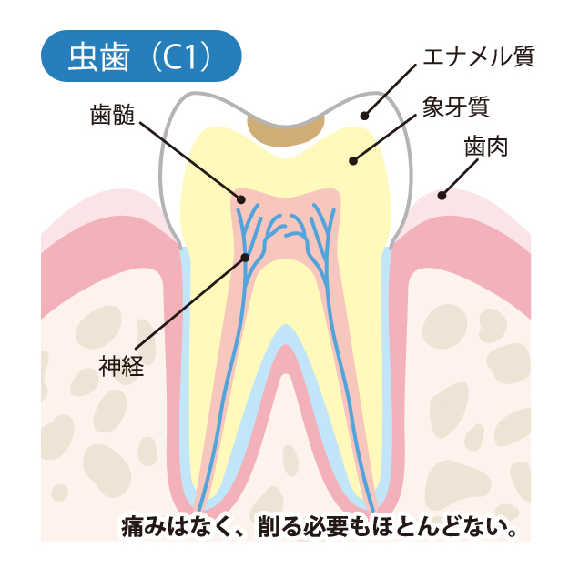 成田（千葉県成田市）の歯医者、メイプル歯科はなのき台クリニックの虫歯治療