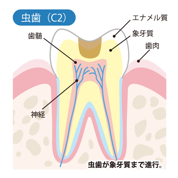 成田（千葉県成田市）の歯医者、メイプル歯科はなのき台クリニックの虫歯治療