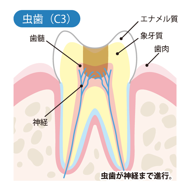 成田（千葉県成田市）の歯医者、メイプル歯科はなのき台クリニックの虫歯治療