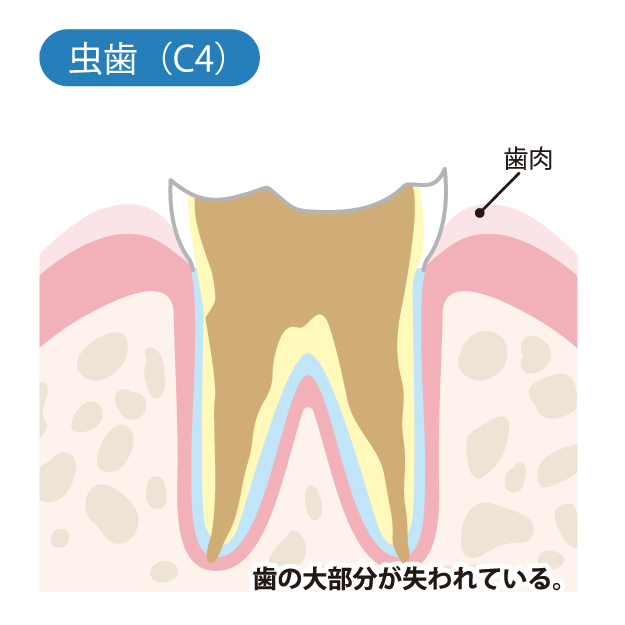 成田（千葉県成田市）の歯医者、メイプル歯科はなのき台クリニックの虫歯治療