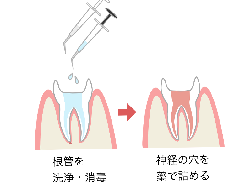 成田（千葉県成田市）の歯医者、メイプル歯科はなのき台クリニックの根管治療