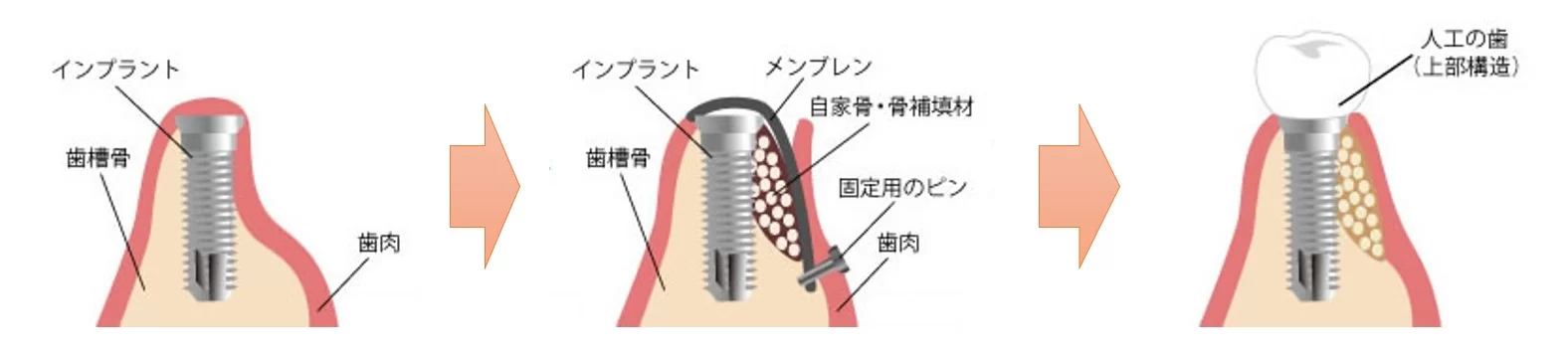 成田（千葉県成田市）の歯医者、メイプル歯科はなのき台クリニックのGBR法