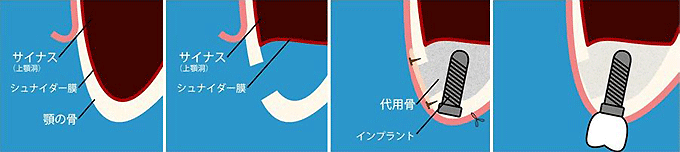 成田（千葉県成田市）の歯医者、メイプル歯科はなのき台クリニックでインプラント