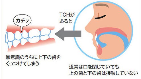 成田（千葉県成田市）の歯医者、メイプル歯科はなのき台クリニックのの歯列接触癖対策