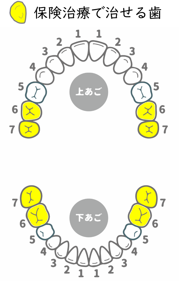 メイプル歯科はなのき台クリニックでPEEK冠