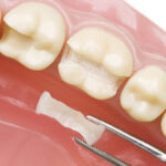 成田（千葉県成田市）の歯医者、メイプル歯科はなのき台クリニックで詰め物や被せ物が取れた場合の対処法についての解説