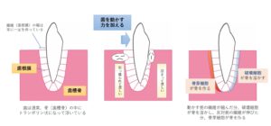 成田（千葉県成田市）の歯医者、メイプル歯科はなのき台クリニックで矯正後の後戻りについての解説