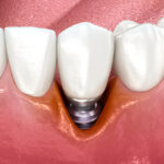 成田（千葉県成田市）の歯医者、メイプル歯科はなのき台クリニックで介護が必要な高齢者の口腔ケア方法と誤嚥性肺炎予防のポイントを解説