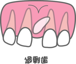 成田（千葉県成田市）の歯医者、メイプル歯科はなのき台クリニックで歯が通常より多い「過剰歯」が引き起こすトラブルと日々のケア方法・治療法を解説