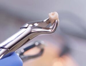 成田（千葉県成田市）の歯医者、メイプル歯科はなのき台クリニックで歯が通常より多い「過剰歯」が引き起こすトラブルと日々のケア方法・治療法を解説