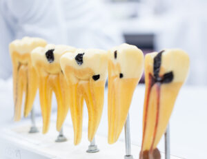 成田（千葉県成田市）の歯医者、メイプル歯科はなのき台クリニックで歯が通常より多い「過剰歯」が引き起こすトラブルと日々のケア方法・治療法を解説