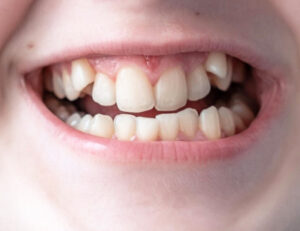 成田（千葉県成田市）の歯医者、メイプル歯科はなのき台クリニックで歯が通常より多い「過剰歯」が引き起こすトラブルと日々のケア方法・治療法を解説