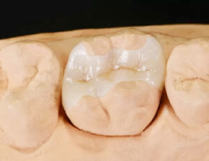 成田（千葉県成田市）の歯医者、メイプル歯科はなのき台クリニックで詰め物と歯の境目が茶色く変色するのはなぜ？二次カリエスの予防法を解説