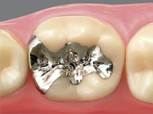 成田（千葉県成田市）の歯医者、メイプル歯科はなのき台クリニックで詰め物と歯の境目が茶色く変色するのはなぜ？二次カリエスの予防法を解説