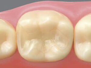 成田（千葉県成田市）の歯医者、メイプル歯科はなのき台クリニックで詰め物と歯の境目が茶色く変色するのはなぜ？二次カリエスの予防法を解説