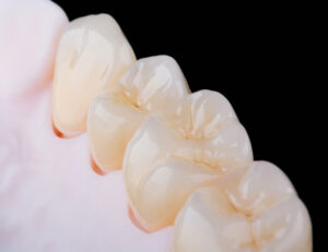 成田（千葉県成田市）の歯医者、メイプル歯科はなのき台クリニックで詰め物と歯の境目が茶色く変色するのはなぜ？二次カリエスの予防法を解説