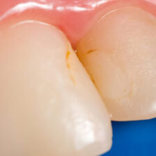 成田（千葉県成田市）の歯医者、メイプル歯科はなのき台クリニックで詰め物と歯の境目が茶色く変色するのはなぜ？二次カリエスの予防法を解説