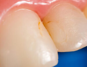 成田（千葉県成田市）の歯医者、メイプル歯科はなのき台クリニックで詰め物と歯の境目が茶色く変色するのはなぜ？二次カリエスの予防法を解説