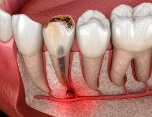 成田（千葉県成田市）の歯医者、メイプル歯科はなのき台クリニックで夜間・休日の歯の激痛対処法と救急外来診療を受診する際の判断基準を解説
