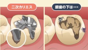 フロスがいつも同じ場所で引っかかるのはなぜ？原因と放置すべきでない理由を解説